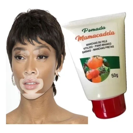 Pomada De Vitiligo Resolve Mesmo Cura Completa Original