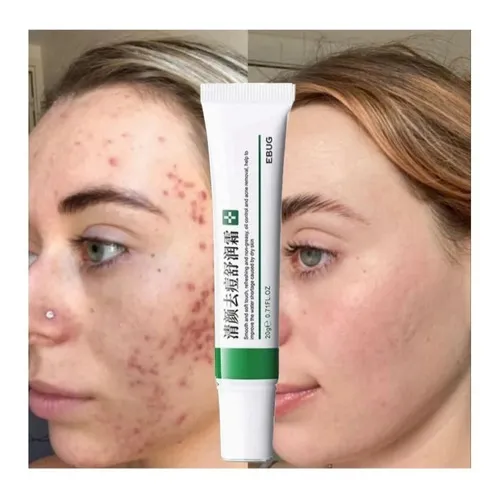 Pomada Creme Removedor Clareador Manchas Acne Sardas 20g Momento de aplicação Dia/Noite Tipo de pele Todo tipo de pele
