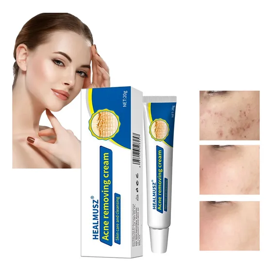 Crema Antiacné Efectiva-reduce Espinillas Y Previene Brotes