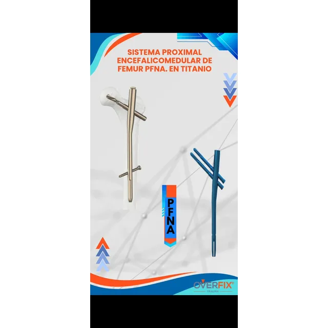 Clavo Bloqueado Proximal De Femur Pfn
