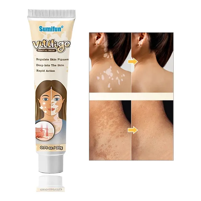 Crema Natual  China Para Vitiligo