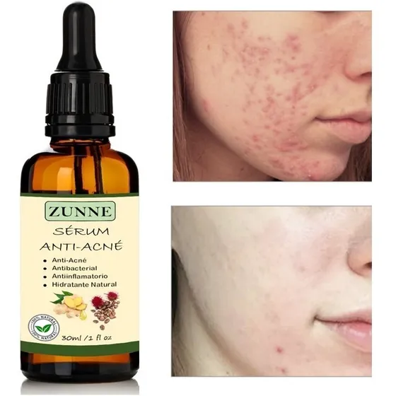 Sérum Anti-acné Libre De Químicos/ Aceites Puros Y Orgánicos