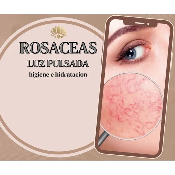 Rosaceas Con Luz Pulsada Intensa (caballito)