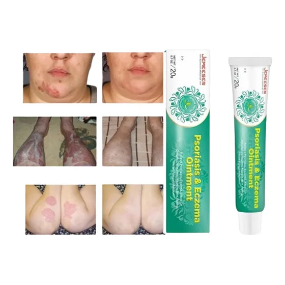 Crema Para Dermatitis, Eczema, Tratamiento De Psoriasis
