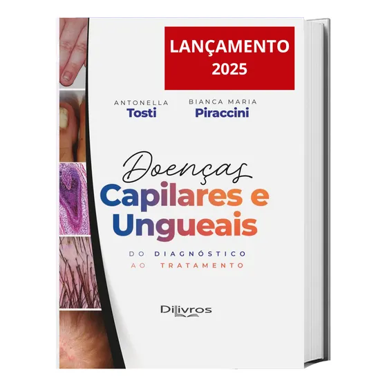 Livro Doenças Capilares E Ungueais  2025 - Guia Completo E Atualizado Para Diagnóstico E Tratamento Dermatológico Rapido Seguro - Antonella Tosti / Bianca Maria Piraccini