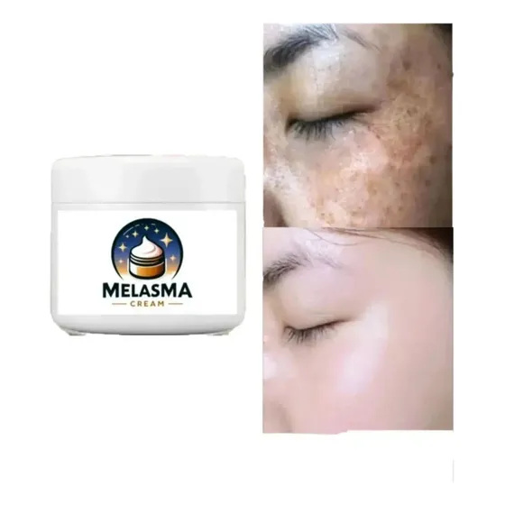 Creme Tira Remove Manchas Acne Melasma Sardas 30g