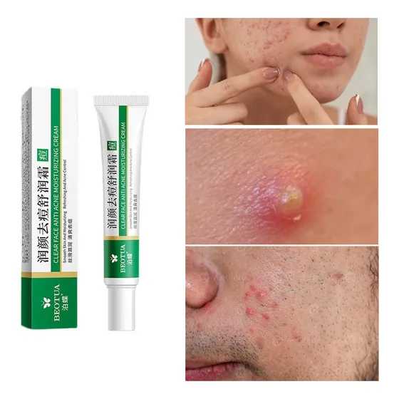 O2 Creme Ótimo Para Acabar Com Acne E Espinhas