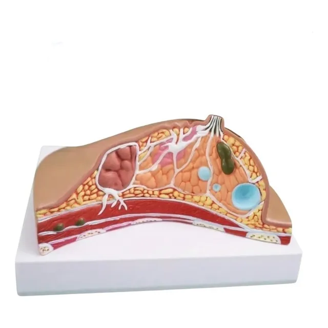 Maqueta De Mama En Vista Transversal Con Cáncer Y Patologías