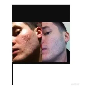 Ácido Retinóico 0,5% + Hidroquinona 4% + Alfa-bisabolol 2%