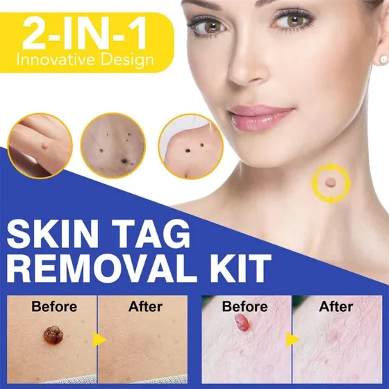 Removedor De Verrugas Skin Tag Kit Para Todo Tipo De Piel