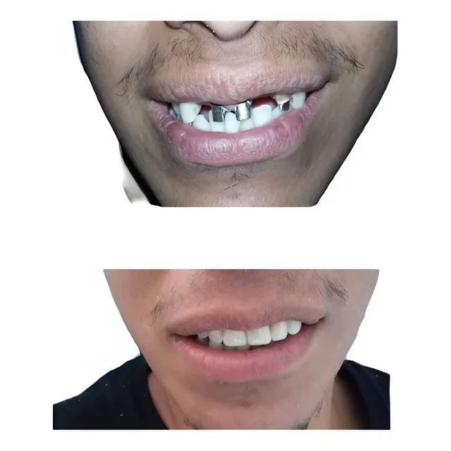 Corona Dental Acrílico Provisoria En El Acto 