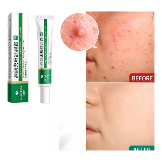 Creme Para Acabar Com Espinhas Acne Tratamento