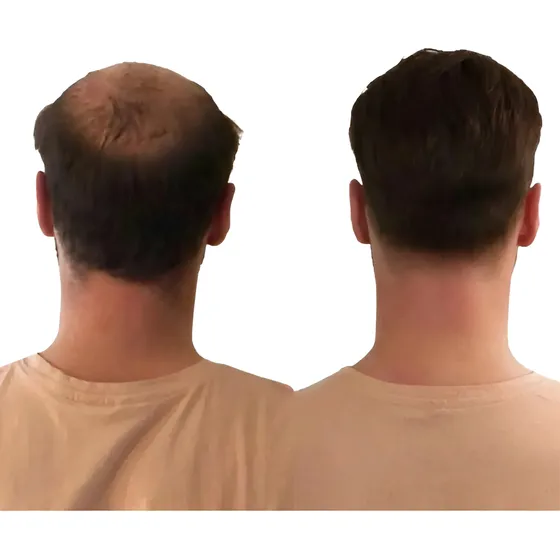Crecimiento Capilar Para Calvicie Y Barba Tónico + Envio