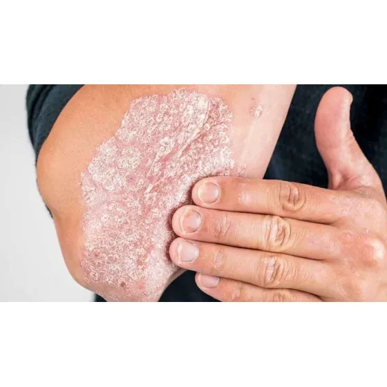 Crema Para Psoriasis