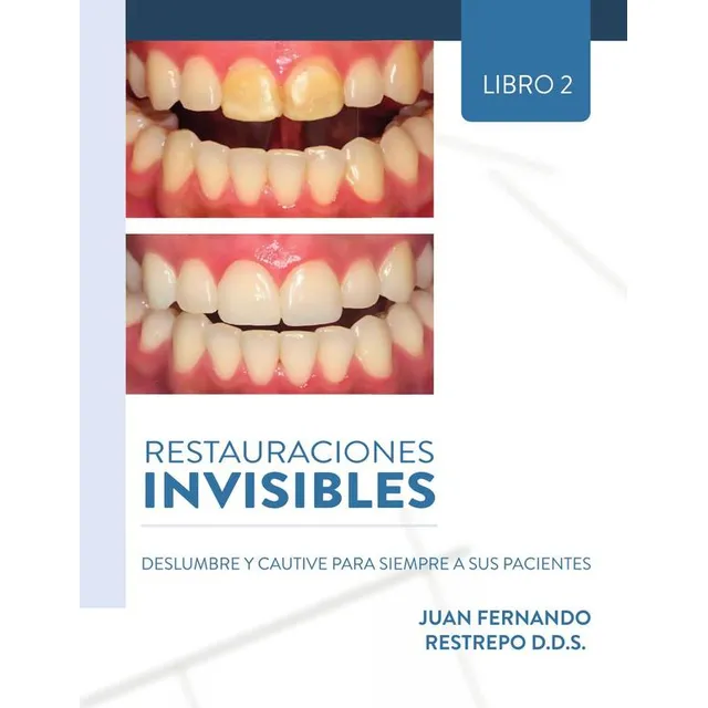 Restauraciones Invisibles:deslumbre Y Cautive Para Siempr...