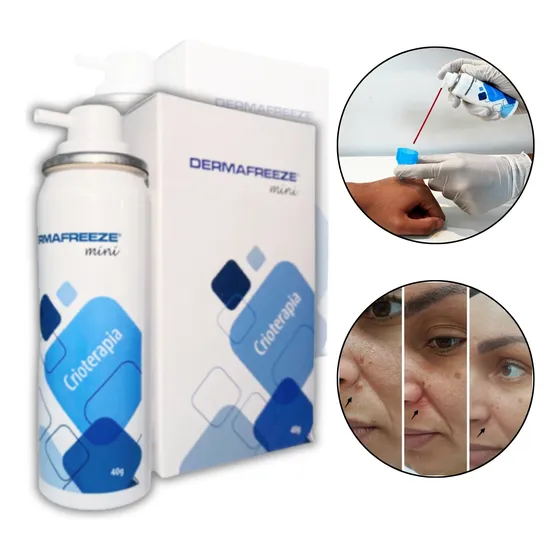 Escolha Certa P/ Tirar Verrugas - Dermafreeze Remove Melhor