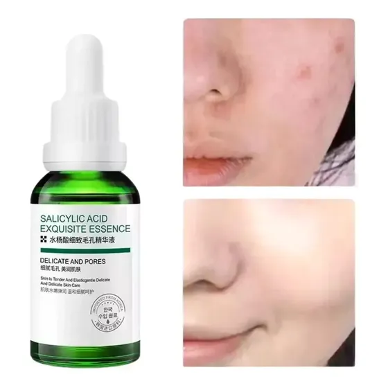 Sérum Facial Con Ácido Salicílico, Reduce Los Poros Y Contro