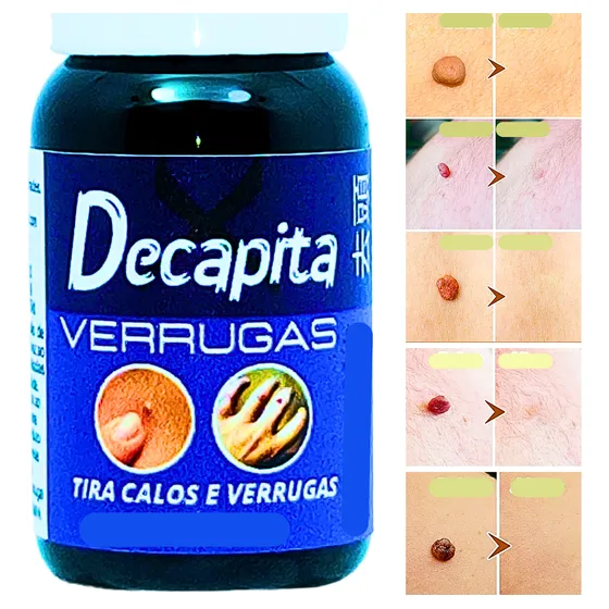 Decapita Verrugas Na Pele Melhor Que Verrux Point Tca/ata