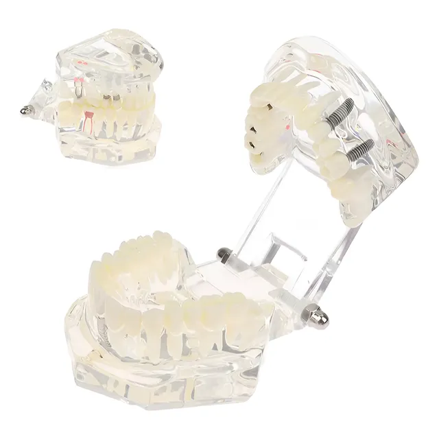 Modelo De Odontologia Conducto Endodoncia Implante Puente