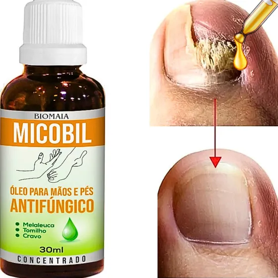Remedio Que Tira Micose De Unha Mata Fungo Unha Cresce Unha