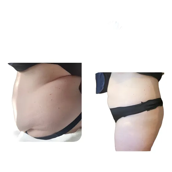Sesiones Lipolaser Corporal - Promoción Especial