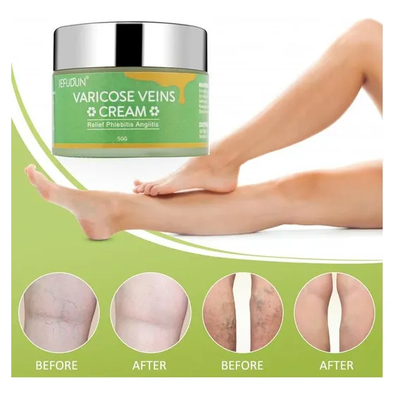 Crema Venosa Con Vetas De Sangre Roja Que Repara Los Moreton