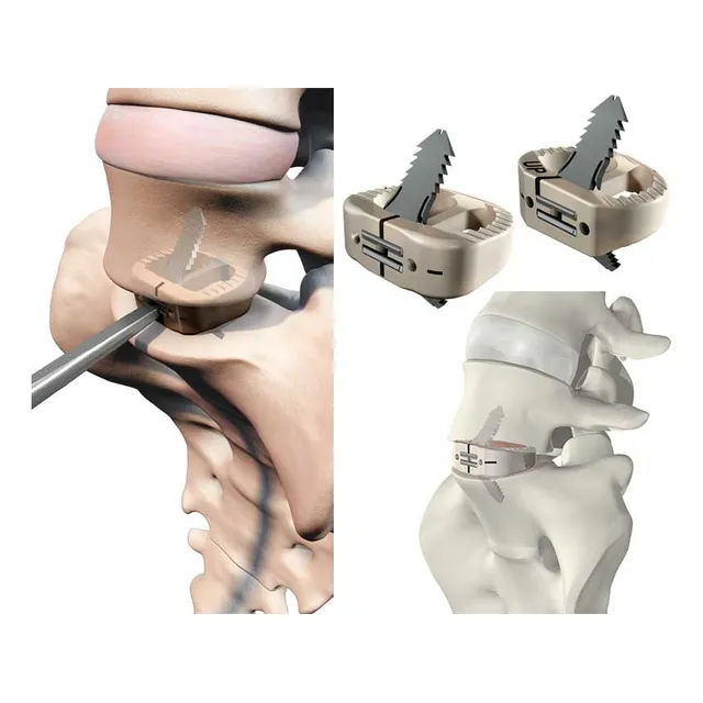 Tornillos , Clavos , Prótesis, Planchas , Quirúrgico