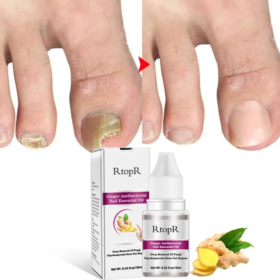 Crema Reparacion De Pies Hongos De Dedos Ataca Onicomicosis