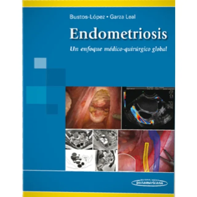 Endometriosis