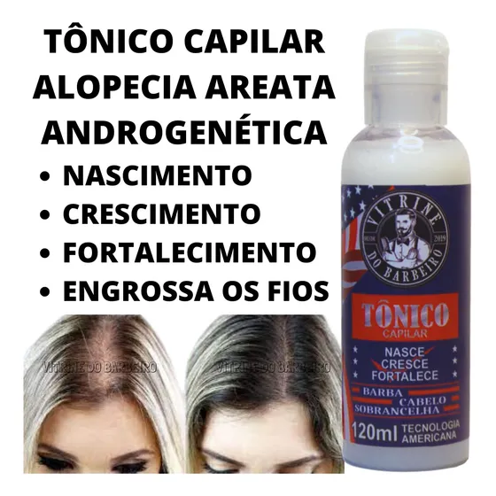 Tratamento Capilar Para Calvície Tônico Anti Alopécia Areata