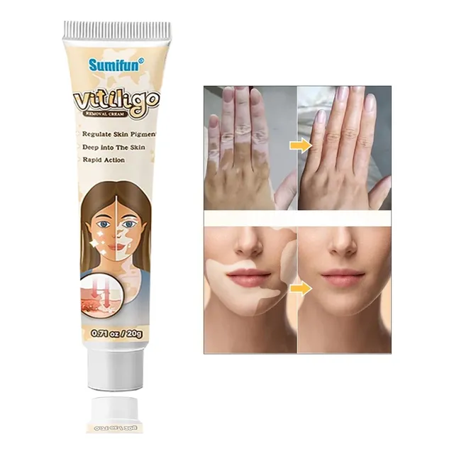 Crema Natual  China Para Tratar Vitiligo