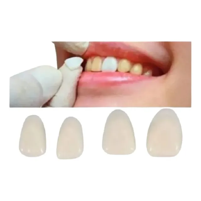14 Facetas Resina + Massa Fixadora.  Dentes Postiços.