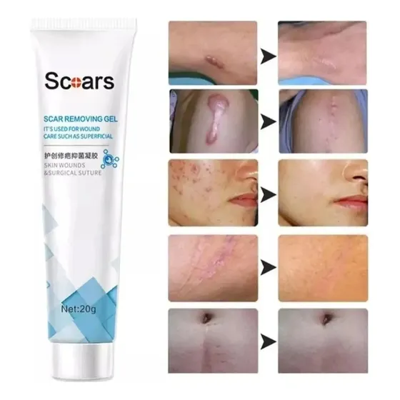 Creme Pomada Creme Tira Remove Cicatriz Queloide 20g Scoars