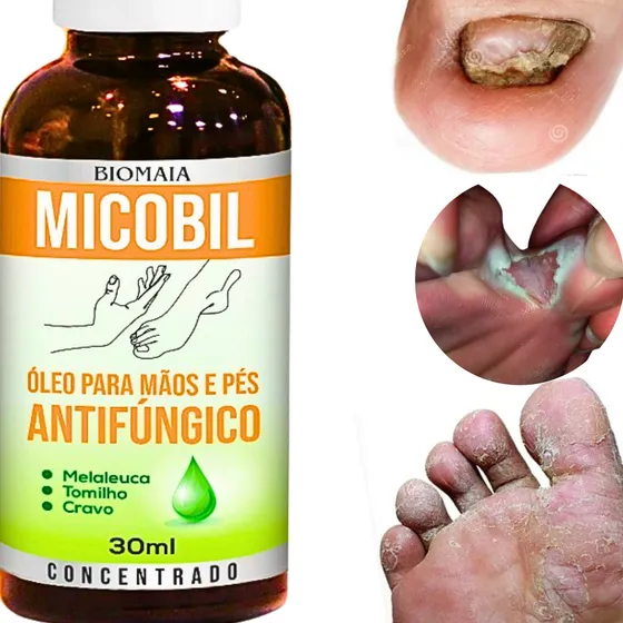 Remédio Para Micose Nas Mãos Micose Pele Micose Na Virilha