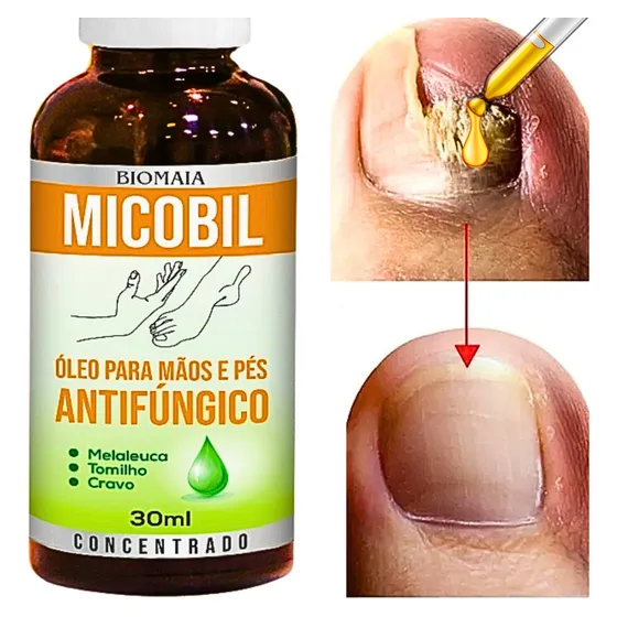 Remedio Que Tira Micose De Unha Mata Fungo nas Mão Pés Dedos Frieiras Unha Quebradiça Onimicose Tinea Micose nas Unhas potente Antimicótico Antifúngico Antimicoses Mata a Micose por Completo