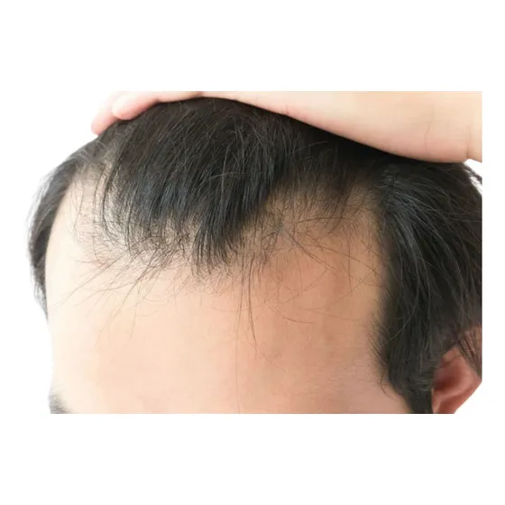 Tratamiento Para Caída De Cabello (mesoterapia)