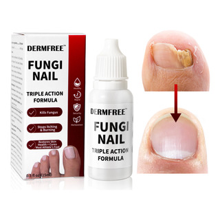 15ml Líquido Para Hongos En Las Uñas-mata Los Hongos En Las 15ml Líquido Para Hongos En Las Uñas-mata Los Hongos En Las