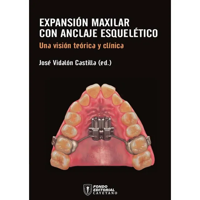 Expansión Maxilar Con Anclaje Esquelético