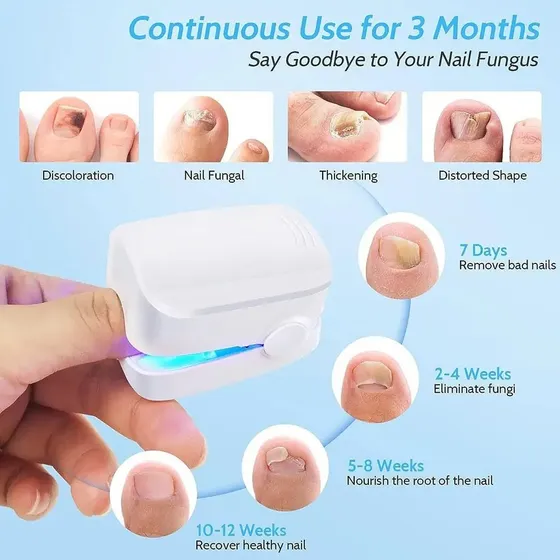 Dispositivo Laser Para Hongos En Uñas