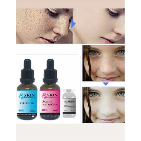 Ácido Retinoico 40%+ Peeling 3d 40%+ Ácido Tca 35%