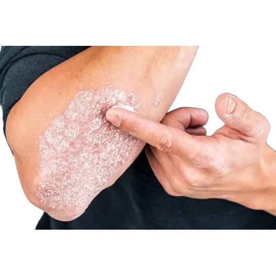 Psoriasis Y Dermatitis
