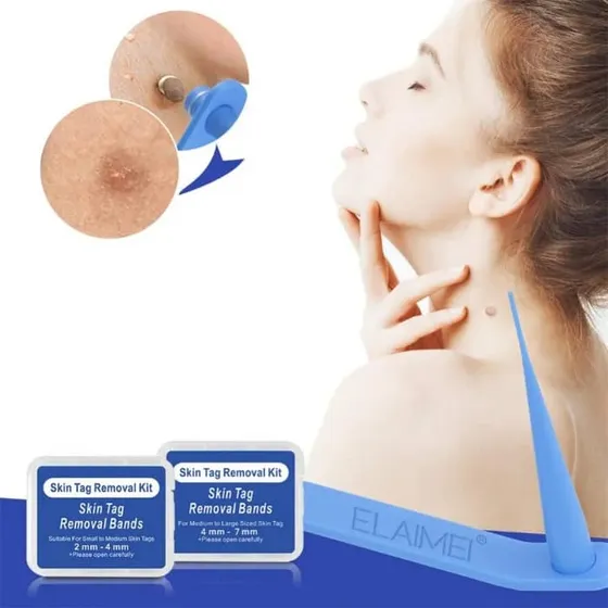 Removedor De Verrugas Skin Tag Removal Kit