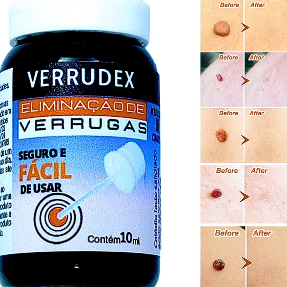 Acido Para Matar Verruga / Como Tirar Verruga Na Hora