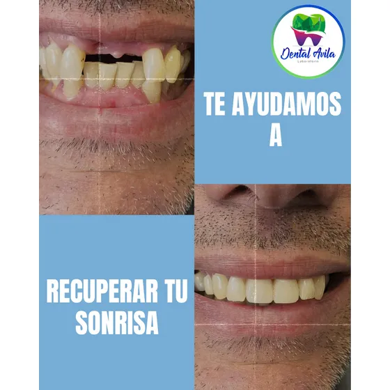 Prótesis Dentales Removibles Y Fijas. Caracas