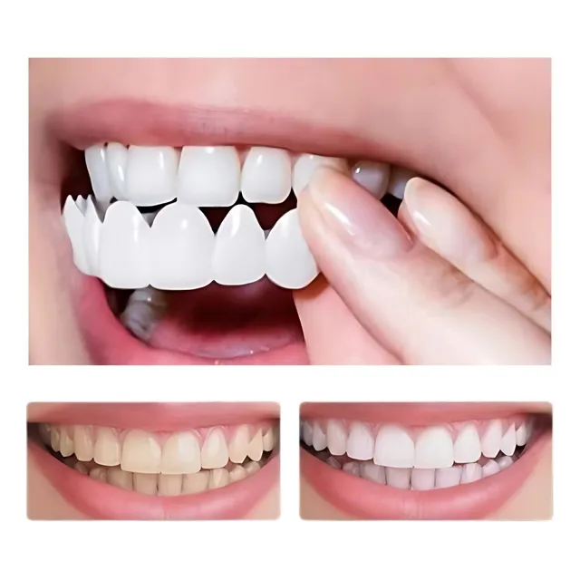 Falsetes Removível Snap On Smile Superior E Inferior (par)