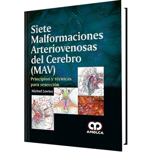 Siete Malformaciones Arteriovenosas Del Cerebro Maf