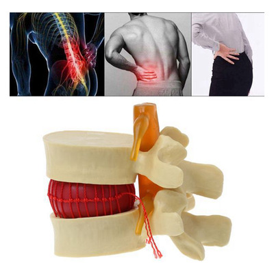 Modelo Anatomico Disco Lombar Coluna Vertebral Humana Hernia