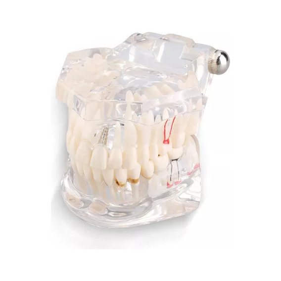 Modelo De Dientes Para Estudio De Enfermedades Dentales Remo