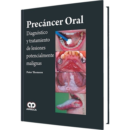 Precáncer Oral. Diagnóstico Y Tratamiento De Lesiones Potencialmente Malignas, De Peter Thomson. Editorial Amolca, Tapa Dura En Español, 2015