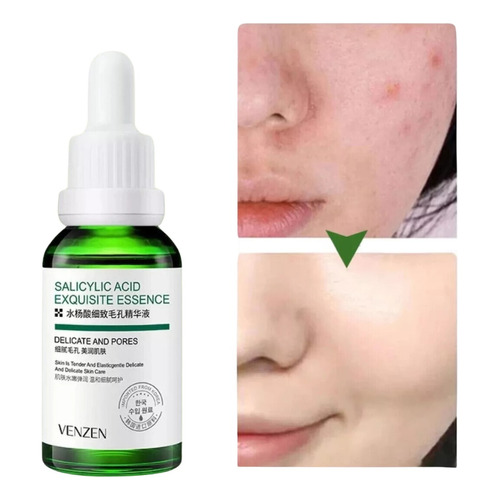 Liquido Antiacne Serum Reparador Espinillas Acido Salicilico Tipo de piel Todo tipo de piel